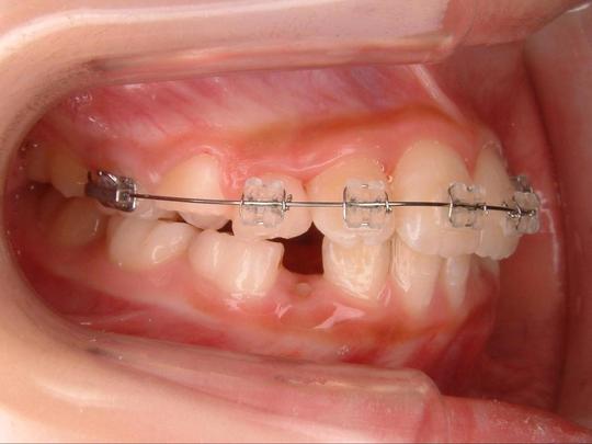 年代別の矯正治療 ふるた矯正歯科 函館